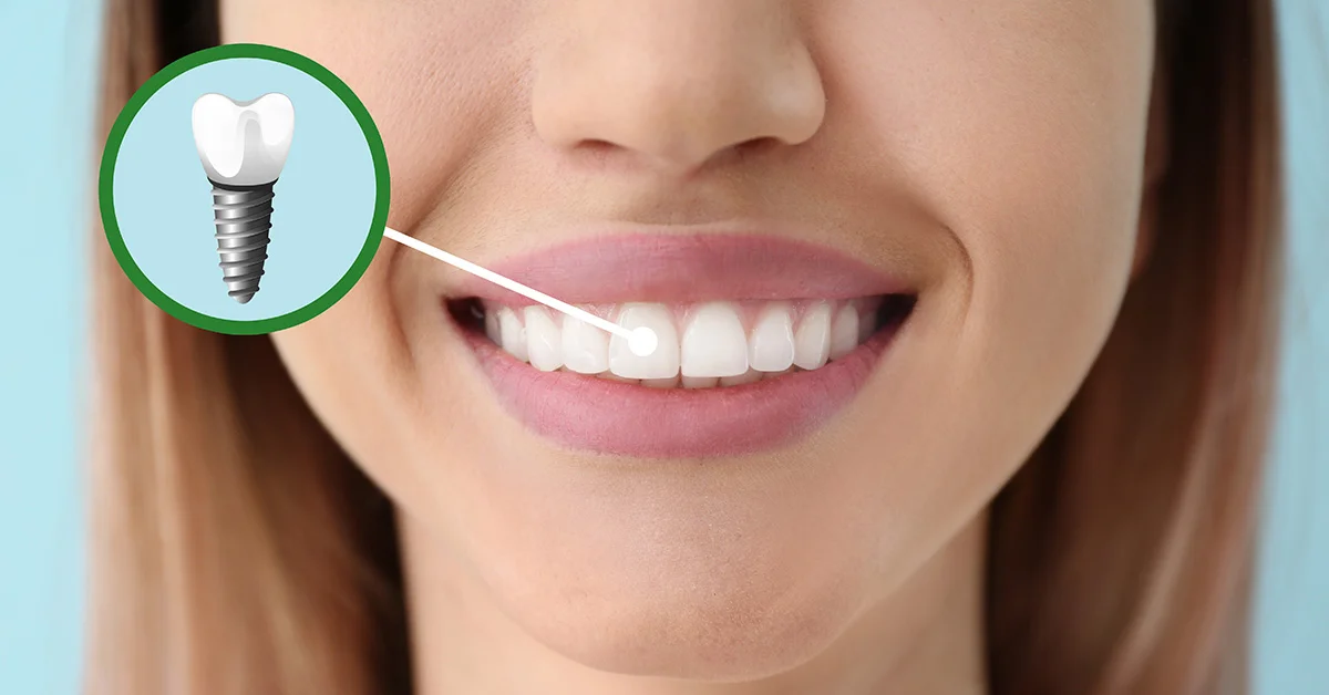 https://www.colinadental.com/services/dental-implants/