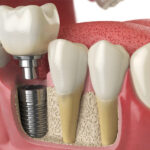 Why hiring a specialist for complicated dental implant cases is a good idea