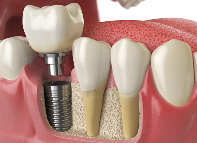 Why hiring a specialist for complicated dental implant cases is a good idea